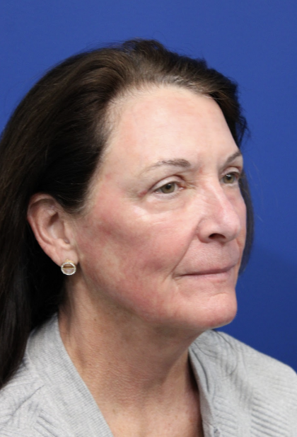 Laser Resurfacing Before & After Patient #5195