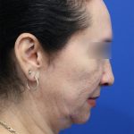 Facelift Before & After Patient #5150