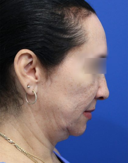 Facelift Before & After Patient #5150