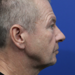 Facelift Before & After Patient #5146
