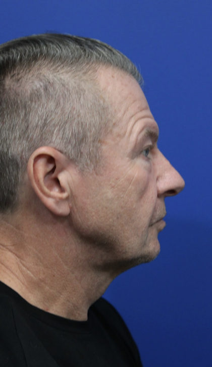 Facelift Before & After Patient #5146