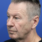 Upper Blepharoplasty Before & After Patient #5147