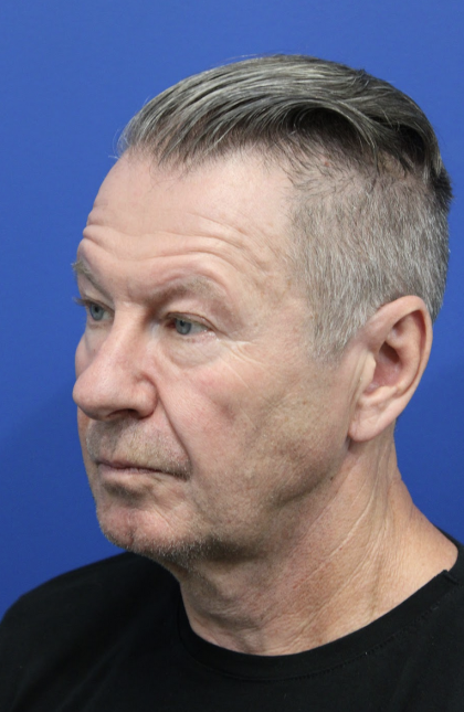 Brow Lift Before & After Patient #5148