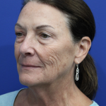 Upper Blepharoplasty Before & After Patient #5193