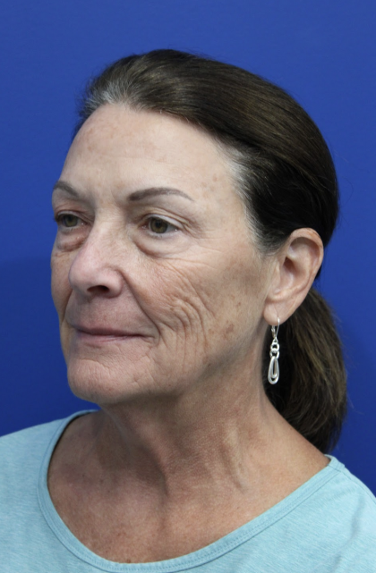 Upper Blepharoplasty Before & After Patient #5193