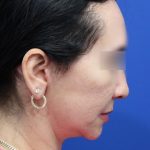 Facelift Before & After Patient #5150