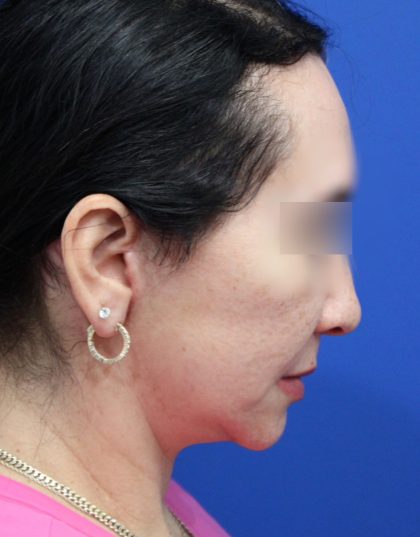 Facelift Before & After Patient #5150