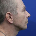 Facelift Before & After Patient #5146