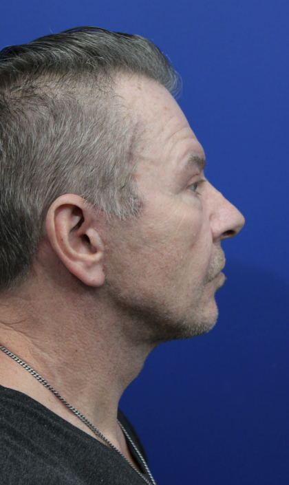 Facelift Before & After Patient #5146