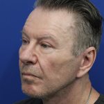 Upper Blepharoplasty Before & After Patient #5147