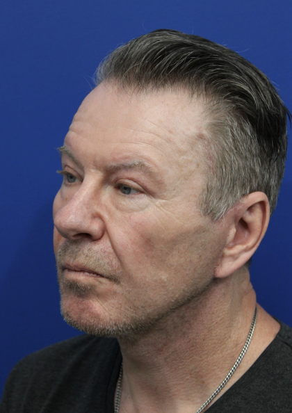 Upper Blepharoplasty Before & After Patient #5147