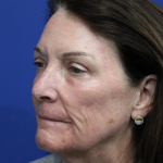 Upper Blepharoplasty Before & After Patient #5193