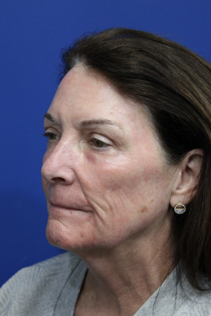 Upper Blepharoplasty Before & After Patient #5193