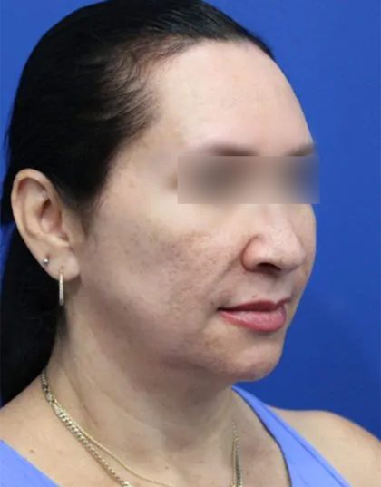 Facelift Before & After Patient #5150