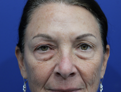 Laser Resurfacing Before & After Patient #5195