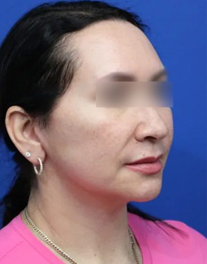 Facelift Before & After Patient #5150