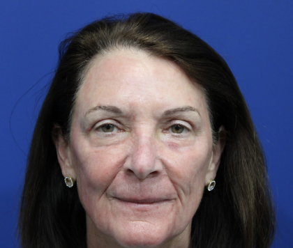Laser Resurfacing Before & After Patient #5195