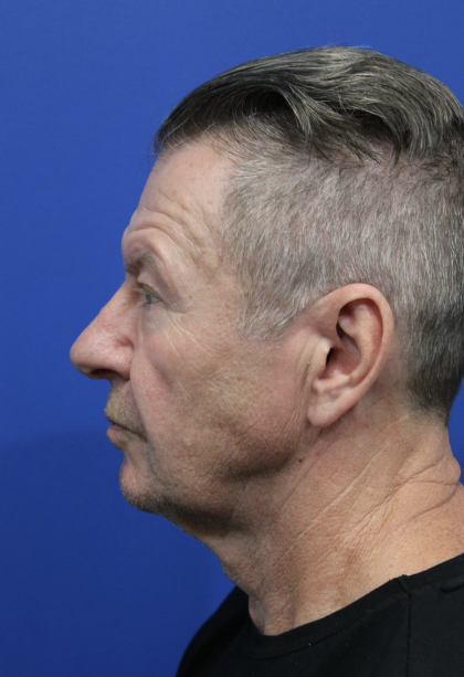 Facelift Before & After Patient #5146