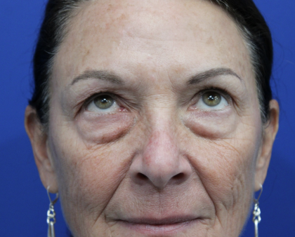 Upper Blepharoplasty Before & After Patient #5193
