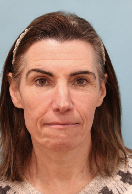 Brow Lift Before & After Patient #5226