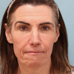 Laser Resurfacing Before & After Patient #5225