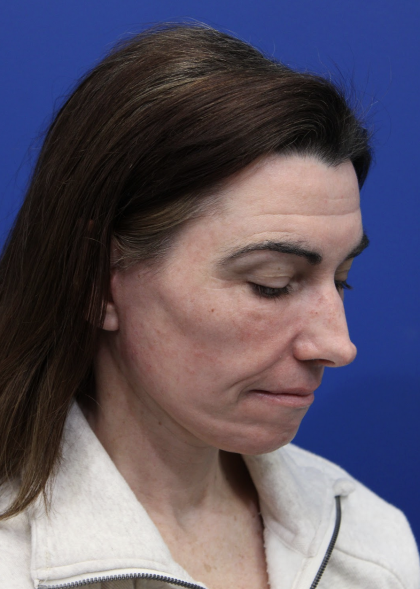 Facelift Before & After Patient #5227