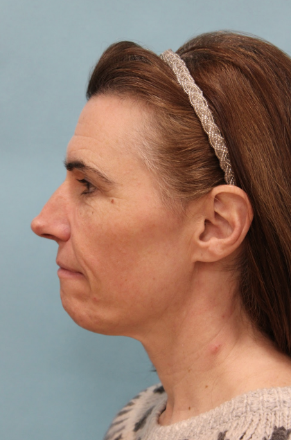 Facelift Before & After Patient #5227