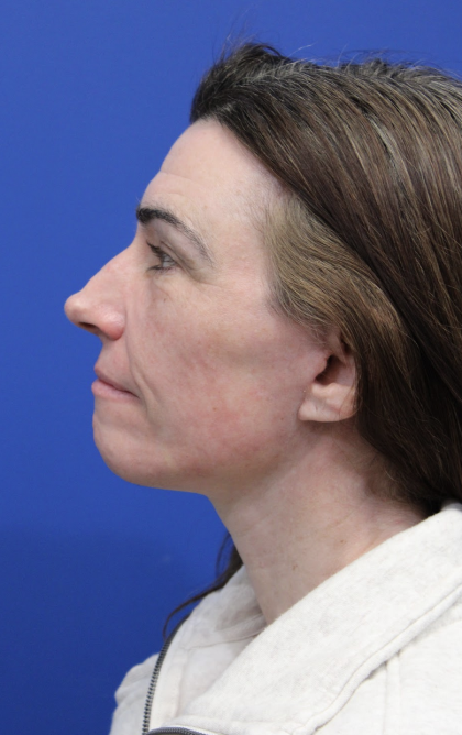 Facelift Before & After Patient #5227