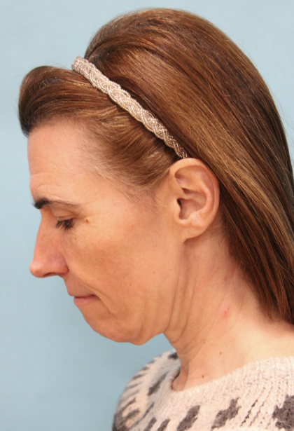 Facelift Before & After Patient #5227