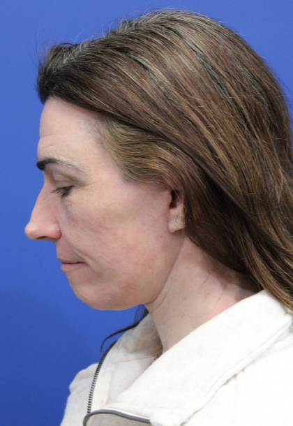 Facelift Before & After Patient #5227