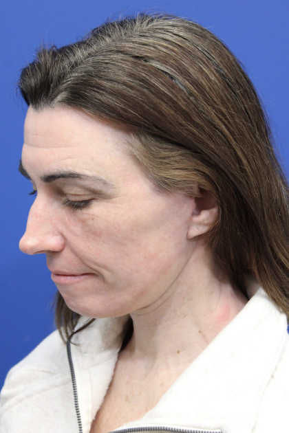 Facelift Before & After Patient #5227