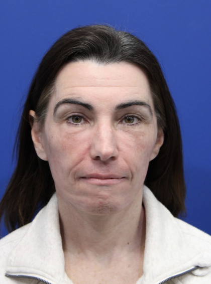 Brow Lift Before & After Patient #5226