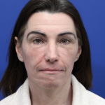Facelift Before & After Patient #5227