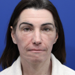 Laser Resurfacing Before & After Patient #5225