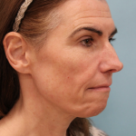Brow Lift Before & After Patient #5226