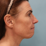 Facelift Before & After Patient #5227