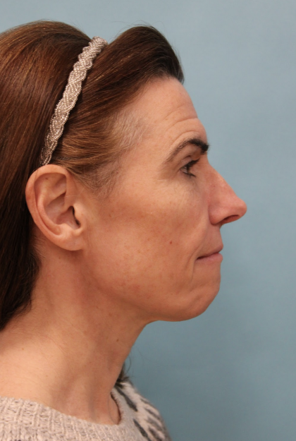 Facelift Before & After Patient #5227