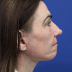 Facelift Before & After Patient #5227