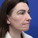 Laser Resurfacing Before & After Patient #5225