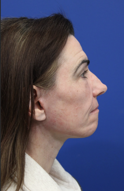 Facelift Before & After Patient #5227