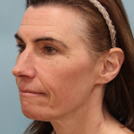 Brow Lift Before & After Patient #5226