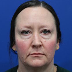Lower Blepharoplasty Before & After Patient #5228