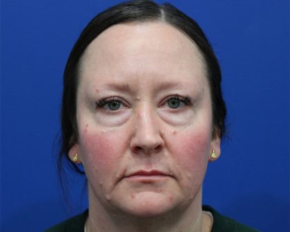 Lower Blepharoplasty Before & After Patient #5228