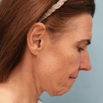 Facelift Before & After Patient #5227