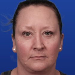 Lower Blepharoplasty Before & After Patient #5228