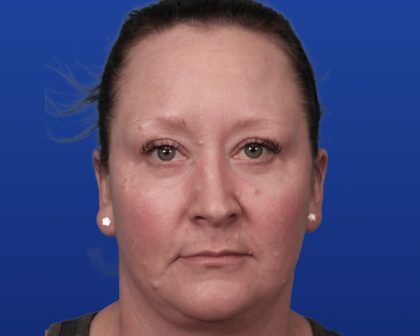 Lower Blepharoplasty Before & After Patient #5228