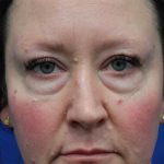 Lower Blepharoplasty Before & After Patient #5228