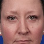 Lower Blepharoplasty Before & After Patient #5228
