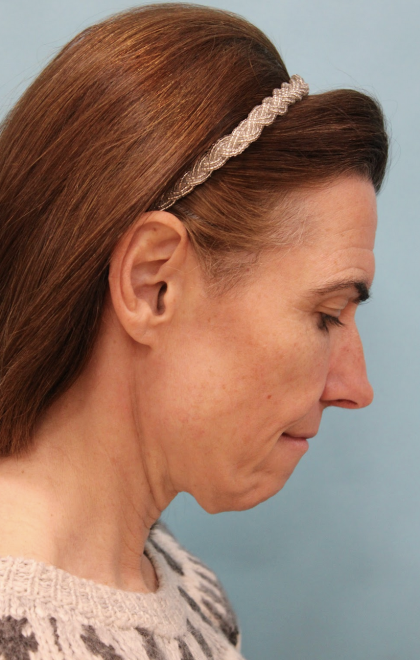 Facelift Before & After Patient #5227