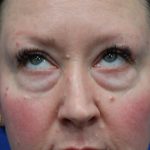 Lower Blepharoplasty Before & After Patient #5228